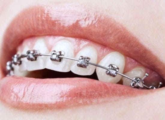 brackets autoligables san fernando de henares