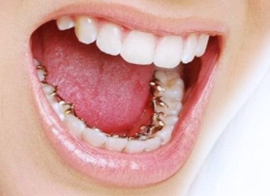 brackets linguales san fernando de henares