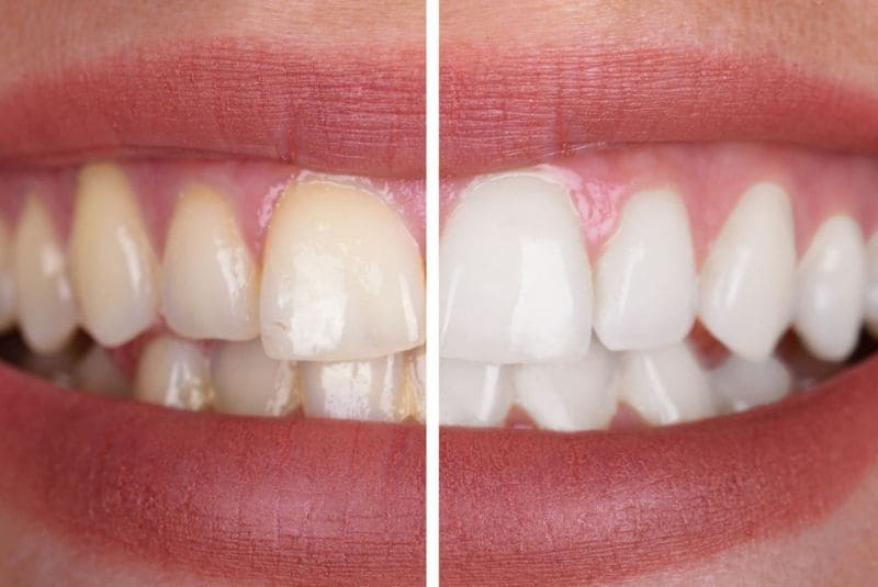 Blanqueamiento dental san fernando henares