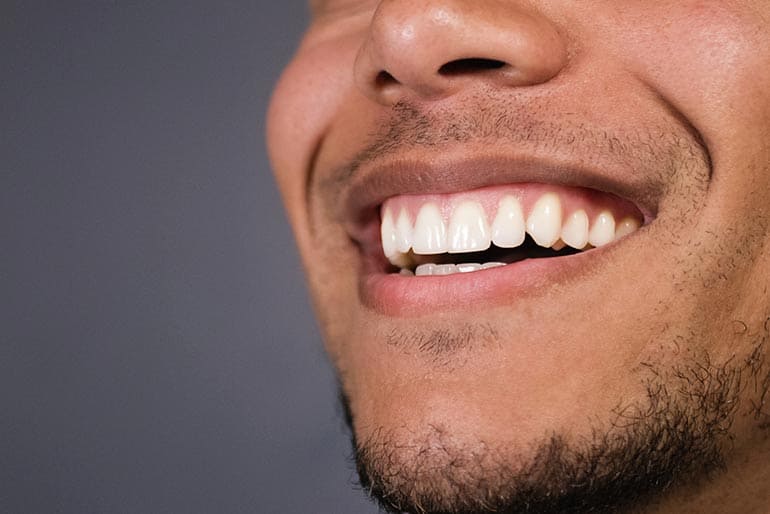 sonrisa gingival san fernando